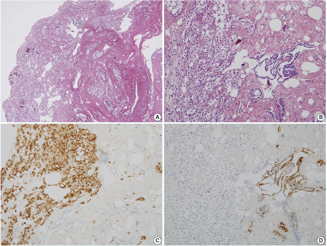 mesothelioma tumours