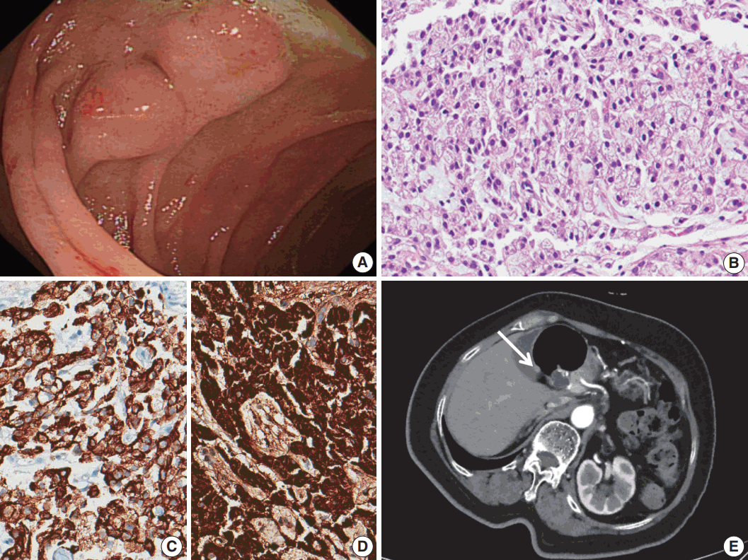 neuroendocrine cancer duodenum