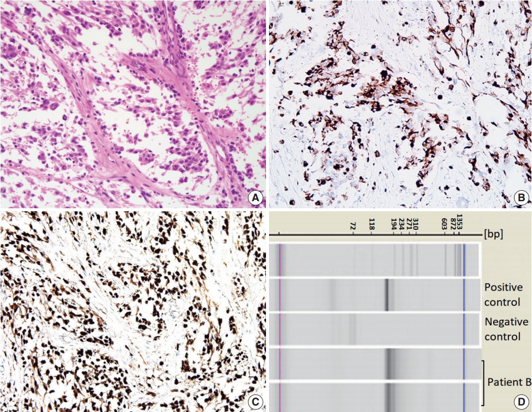 mesothelioma and neck swelling