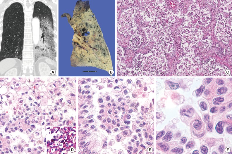 kjpathol-47-603-g001.jpg