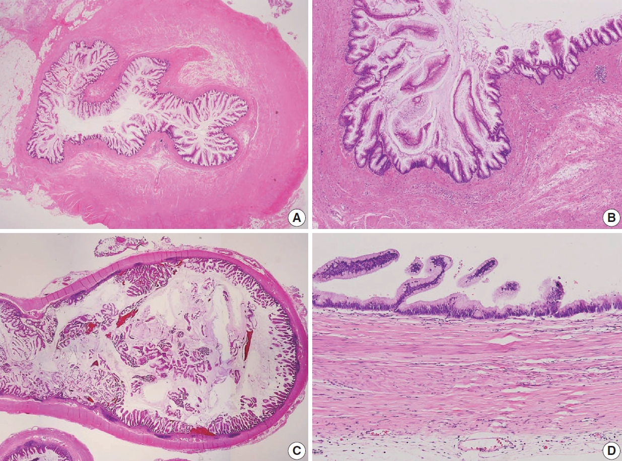 Primary Mucinous Adenocarcinoma of the Vermiform Appendix with High Grade  Microsatellite Instability