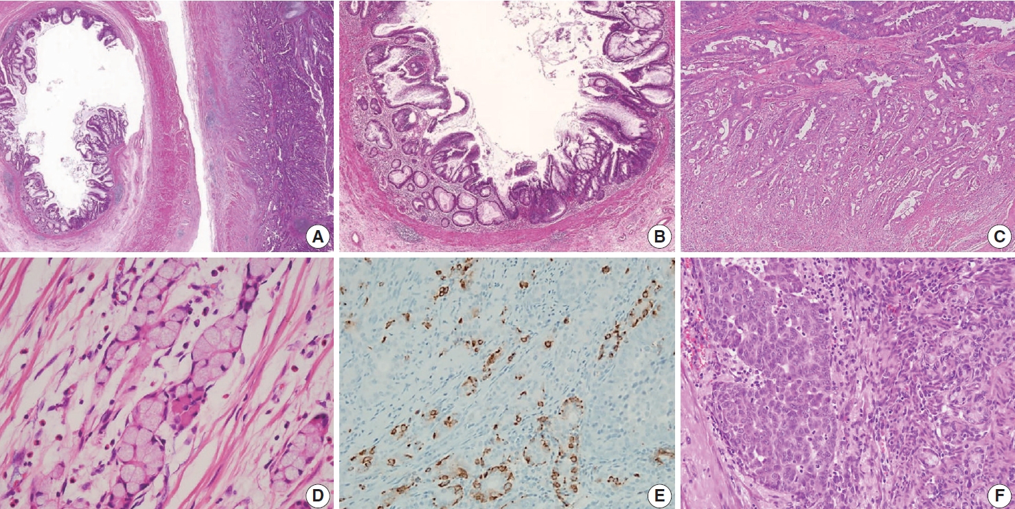 Signet-Ring Cell Carcinoma of Stomach - DoveMed