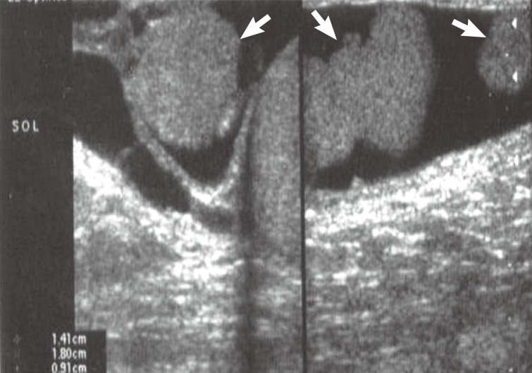 stage ii papillary thyroid cancer