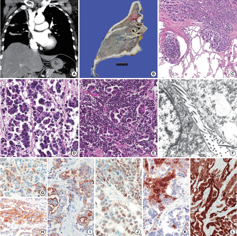 mesothelioma ihc pathology outlines