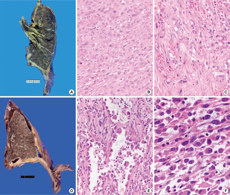 what are mesothelioma complications